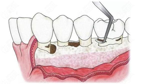 牙周刮治后導致牙齦萎縮更嚴重