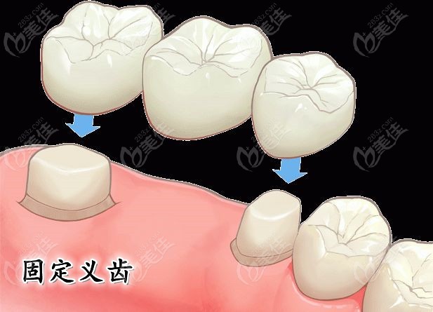 简述可摘局部义齿与固定义齿的区别