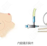 深圳富華隆胸蠻好的