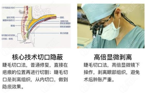 在贵阳华美做过双眼皮修复的人告诉你