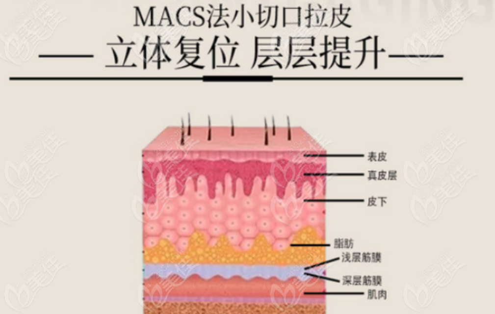 先看macs是拉皮手術(shù)嗎