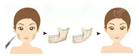 下頜角肥大截骨手術(shù)后遺癥有哪些呢