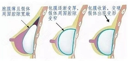 胸部脂肪少做傲諾拉假體豐胸會不會影響手感