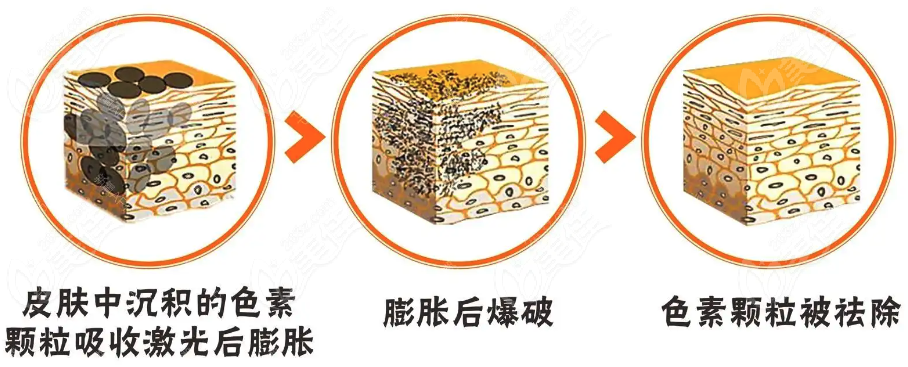 皮秒祛斑的費(fèi)用一般是多少