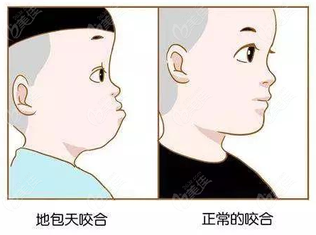 孩子骨性反頜看這里