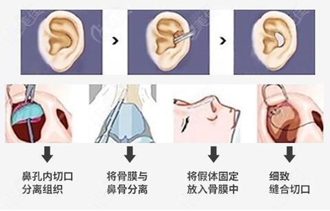 海口美咖整形医院做鼻整形怎么样