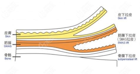 做面部拉皮手術(shù)需要?jiǎng)冸x幾層