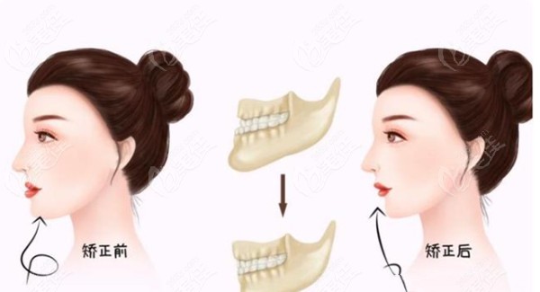 矯正牙齒對臉型變化的影響大嗎