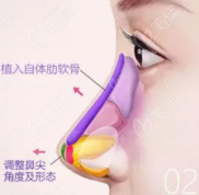 西安米蘭柏羽做鼻子的醫(yī)生排名