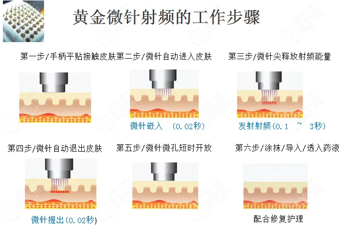 黃金微針對(duì)痘坑真的有用嗎