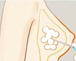 胸部注射膠原蛋白后一直很硬咋回事