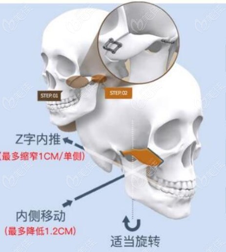 韓國鄭康在和國內(nèi)醫(yī)生張立天誰顴骨內(nèi)推做得好