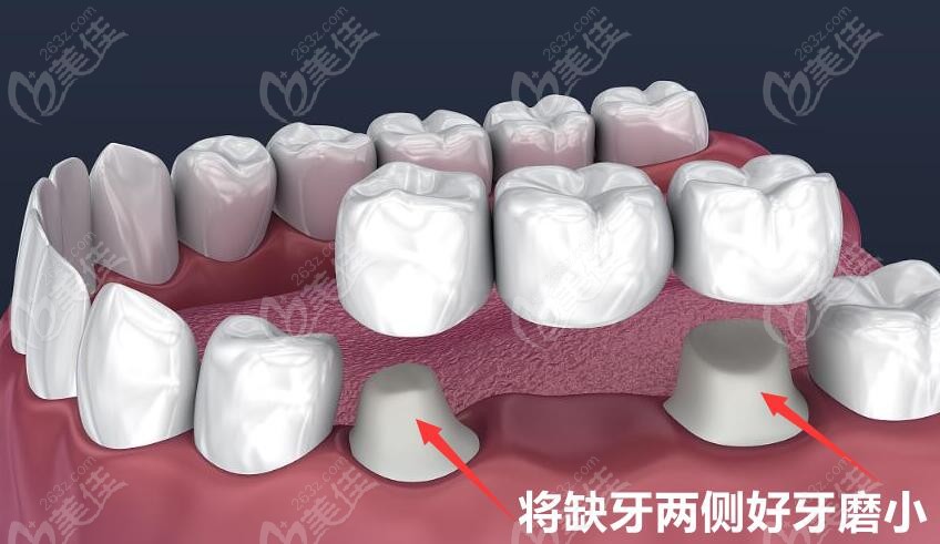 牙冠戴10年了里面牙怎么樣了