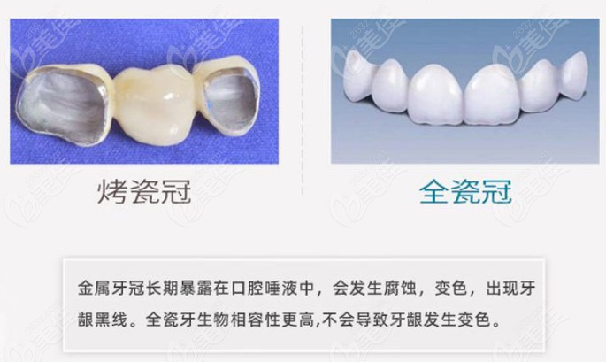 杭州平海路口腔医院种牙价格表为您诠释种牙得花多少钱