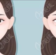 北京豐聯(lián)麗格眼整形修復中心的師麗麗醫(yī)生解析
