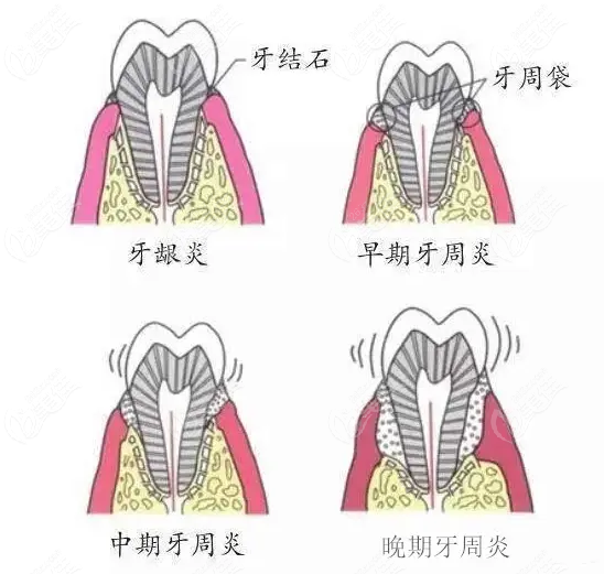 牙周炎一定要全口刮治嗎