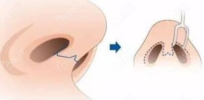 如果做鼻整形手术会留下疤痕