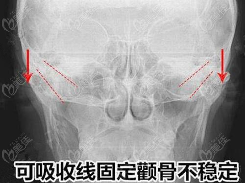 做顴骨內(nèi)推手術(shù)固定用新型的可吸收材料固定顴骨靠譜嗎