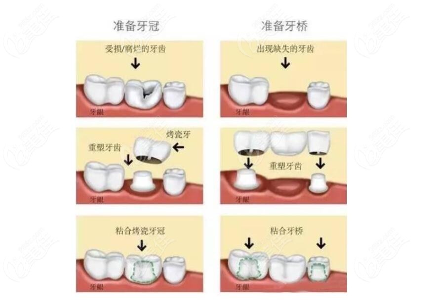 鑲牙過程分為幾個步驟