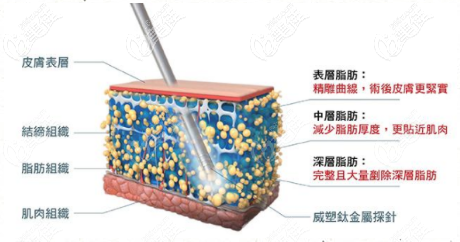 上海能做威塑的整形医院韩啸芒果威塑真正做到纯脂肪吸脂