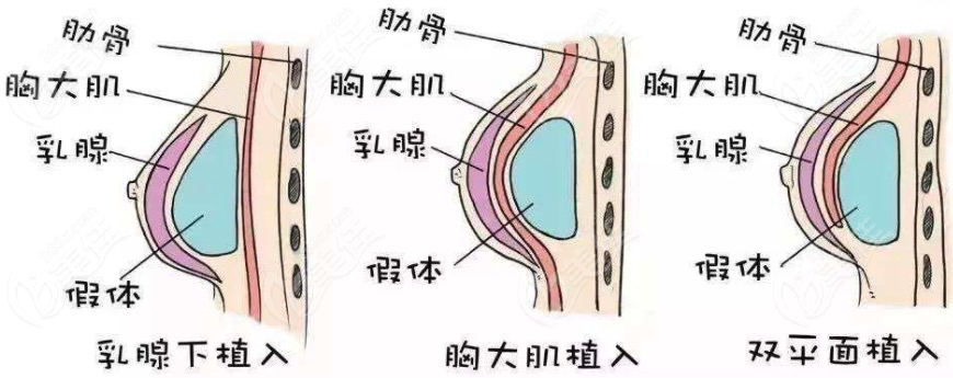 隆胸假体取出手术复杂吗