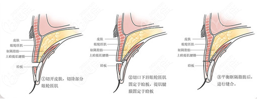 佀同帥擅長哪種雙眼皮類型呢