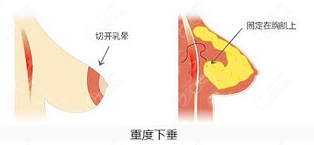 雙環(huán)切口的乳房提升手術(shù)圖解來看乳房雙環(huán)懸吊術(shù)是如何操作的