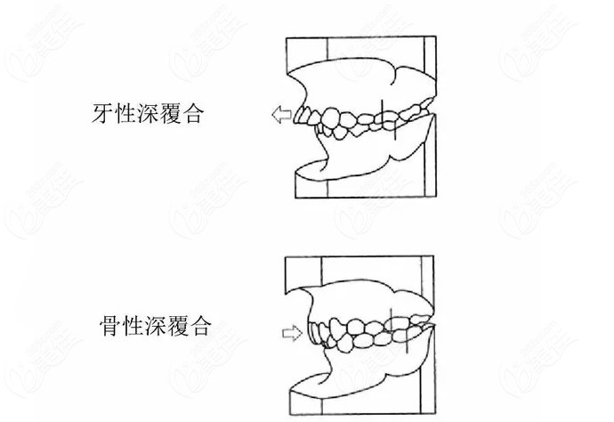 深覆合用平导还是支抗钉