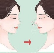 洛陽(yáng)做假體隆鼻價(jià)格是多少