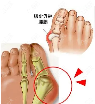 大腳骨手術(shù)哪里做得好