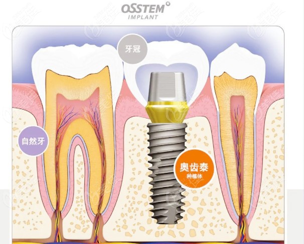 以色列雅植种植体和韩国奥齿泰哪个好