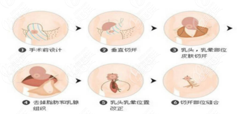 生完孩子多久可以做缩胸手术