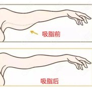 鄭州出名的抽脂醫(yī)生分享