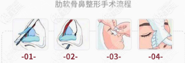 師俊莉醫(yī)生做鼻子的價(jià)格是多少