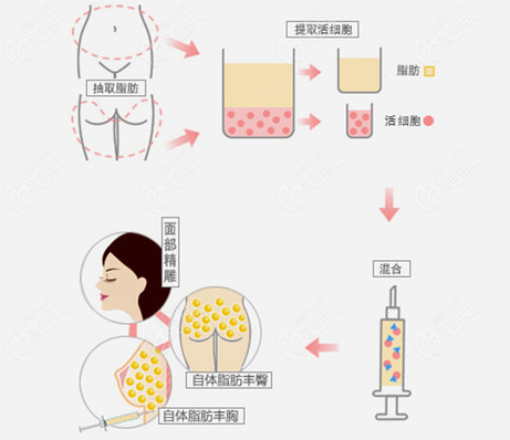 上海自體脂肪填充哪個(gè)醫(yī)生比較好呢