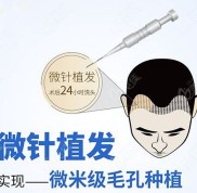 從PSE毛囊移植2024單位的價(jià)格看出pse微針植發(fā)和fue
