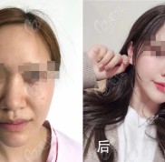 在包頭葉子整形做過耳軟骨鼻綜合的體驗者來告訴大家哪個醫(yī)生鼻子
