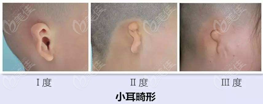 武汉五洲整形做小耳再造的是刘嘉锋医生