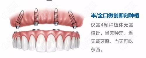 搞清种植牙即拔即种技术的优缺点