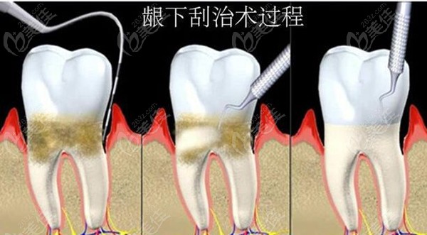 牙周炎刮治費(fèi)用是多少