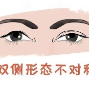 鄭州美眼的田國靜修復(fù)雙眼皮貴嗎