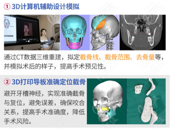 广州正颌手术费用一般是多少钱