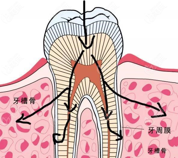 想做烤瓷牙但是没牙根该怎么装