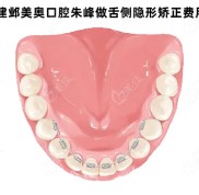 南京建鄴美奧口腔朱峰做舌側(cè)隱形矯正費用貴嗎