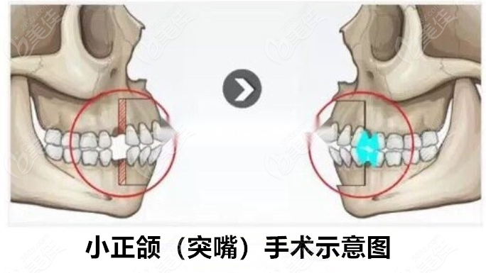 小正颌和大正颌的区别不仅仅是费用不同