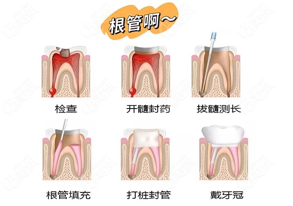 显微根管治疗费用多少