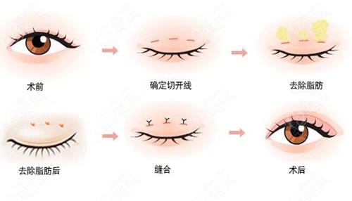 海拉爾做眼綜合要多少錢