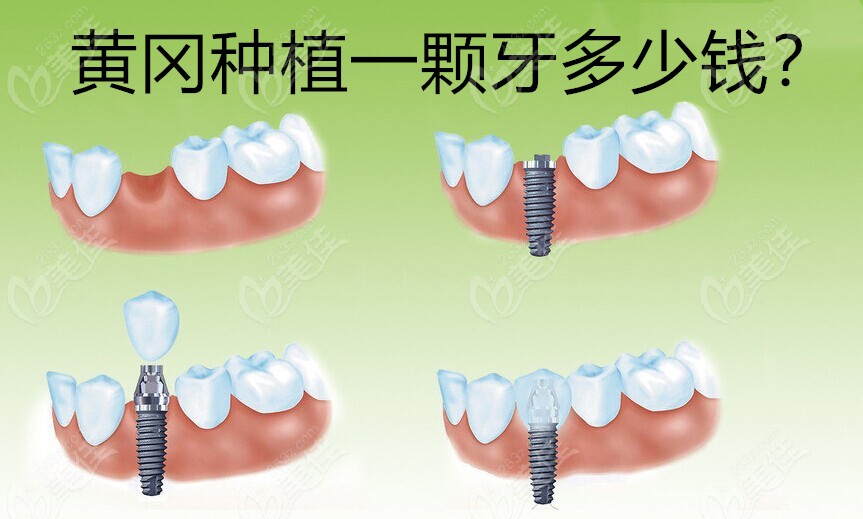 黄冈种植一颗牙多少钱