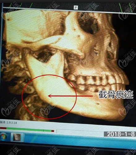 下颌角截骨手术6年后骨头增生是咋回事