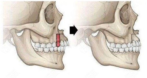正颌手术复发和反弹怎么区别